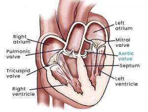 Surgical Aortic Valve Replacement | Apollo CVHF Heart Institute